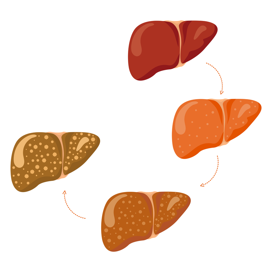 liver-steatosis-progression-from-healthy-to-diseased